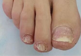 Nail fungus caused problems