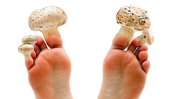 Toenail fungus that can be avoided