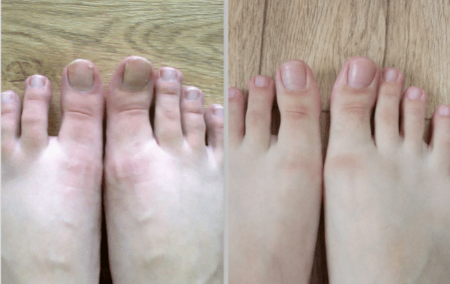 before and after treatment for toenail fungus