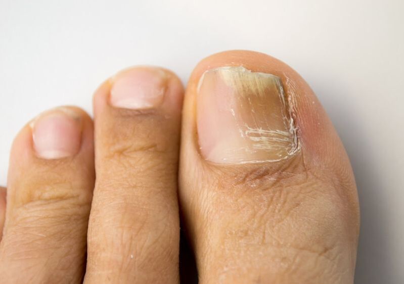 nail fungus on the big toe