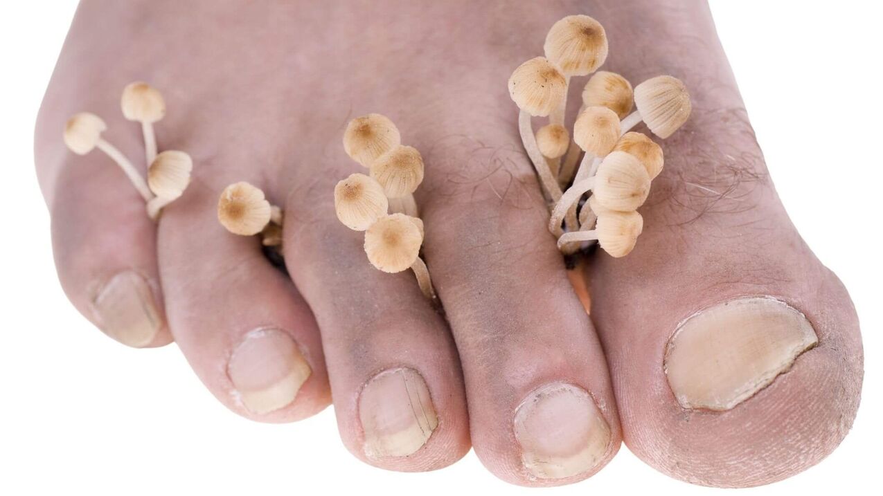 fungal infection of human foot