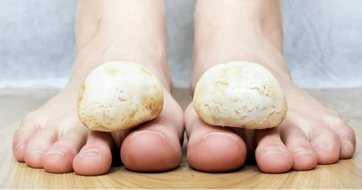 Quick treatment of mushrooms on the legs at home