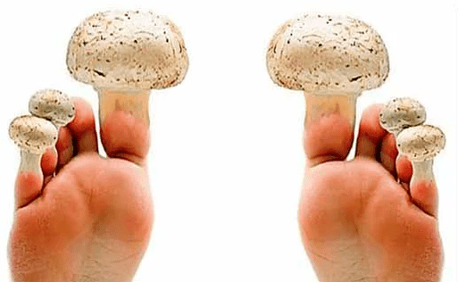 fungus on the nails