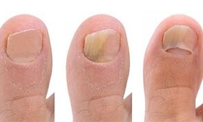 Mushroom development stages on the thumb of the leg