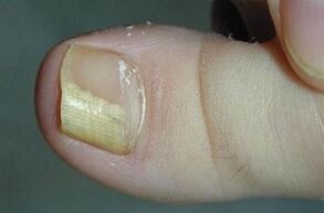 The reasons for the appearance of the fungus on the thumb of the leg