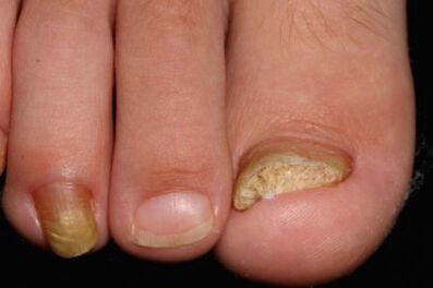 Micose nails on the legs
