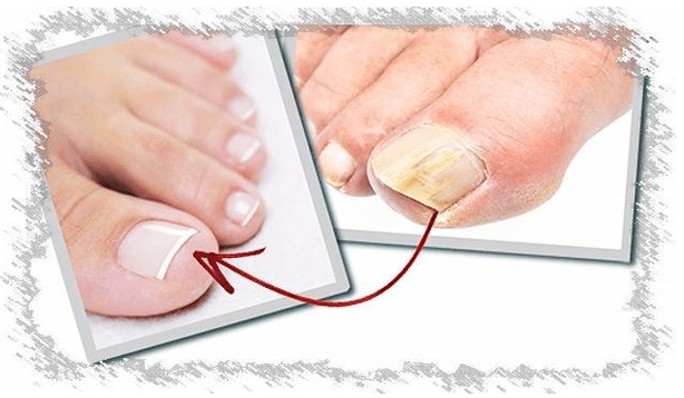 Causes of nail mushrooms