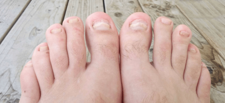 Nail mushroom