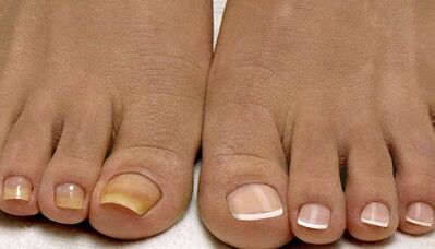 The causes of the mushroom appearance on the nails