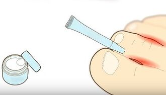 how to treat fungus on toes
