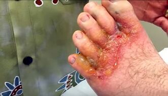 symptoms of fungus on toes