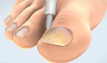collection of onychomycosis scraping