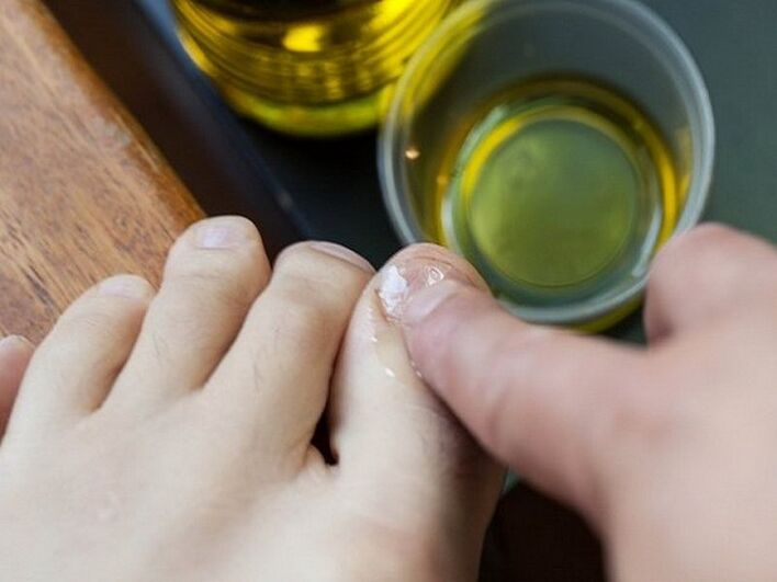 Apply medicated oil to nails affected by fungus