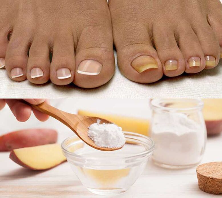 Soda to treat nail fungus