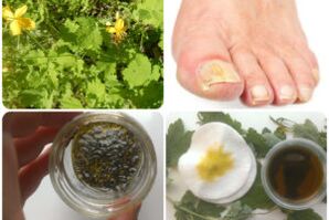 folk remedies for toenail fungus