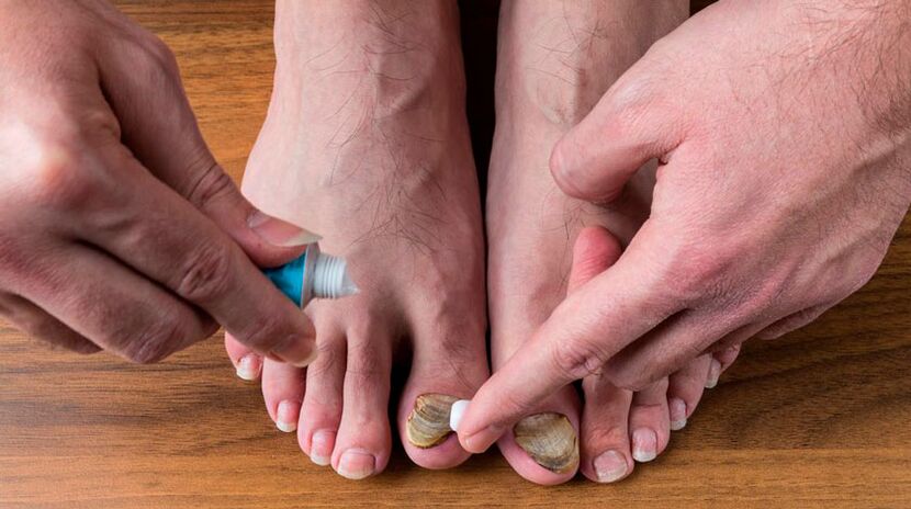 Apply an antifungal cream to toenails to treat onychomycosis